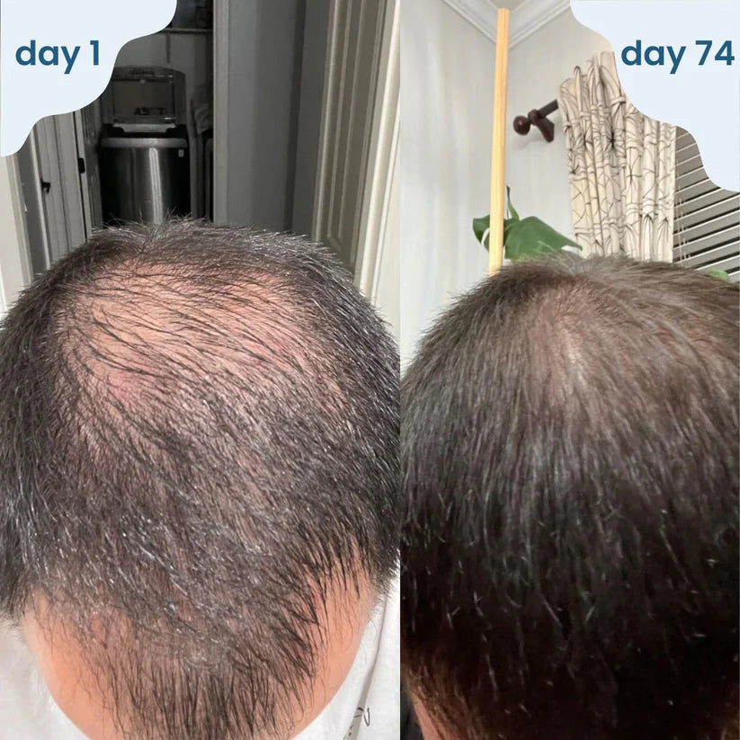 Hair Growth Roll-On