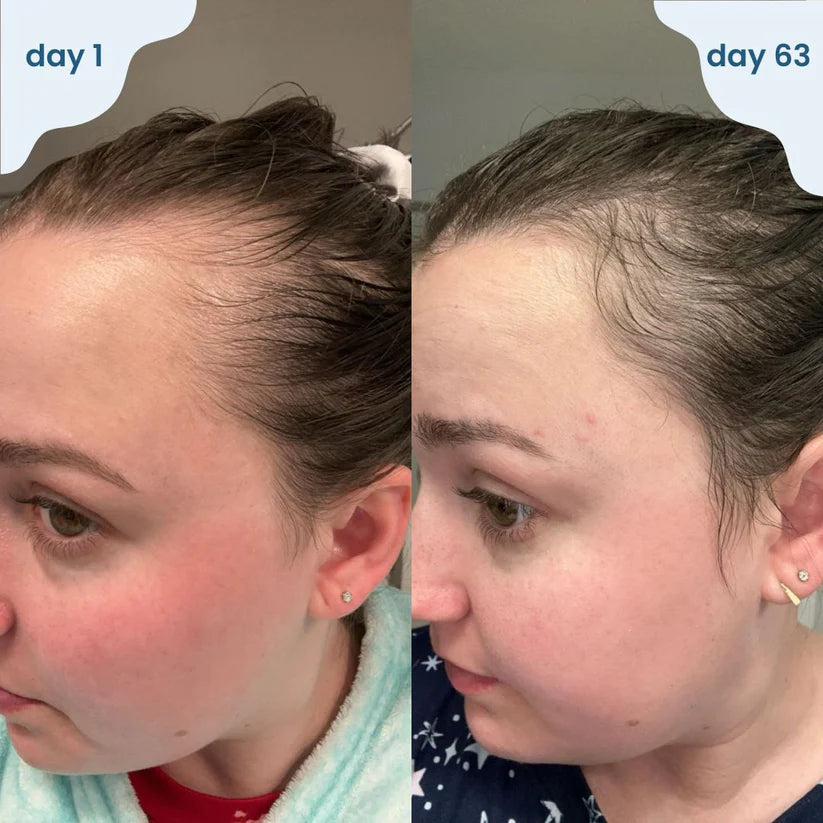 Hair Growth Roll-On