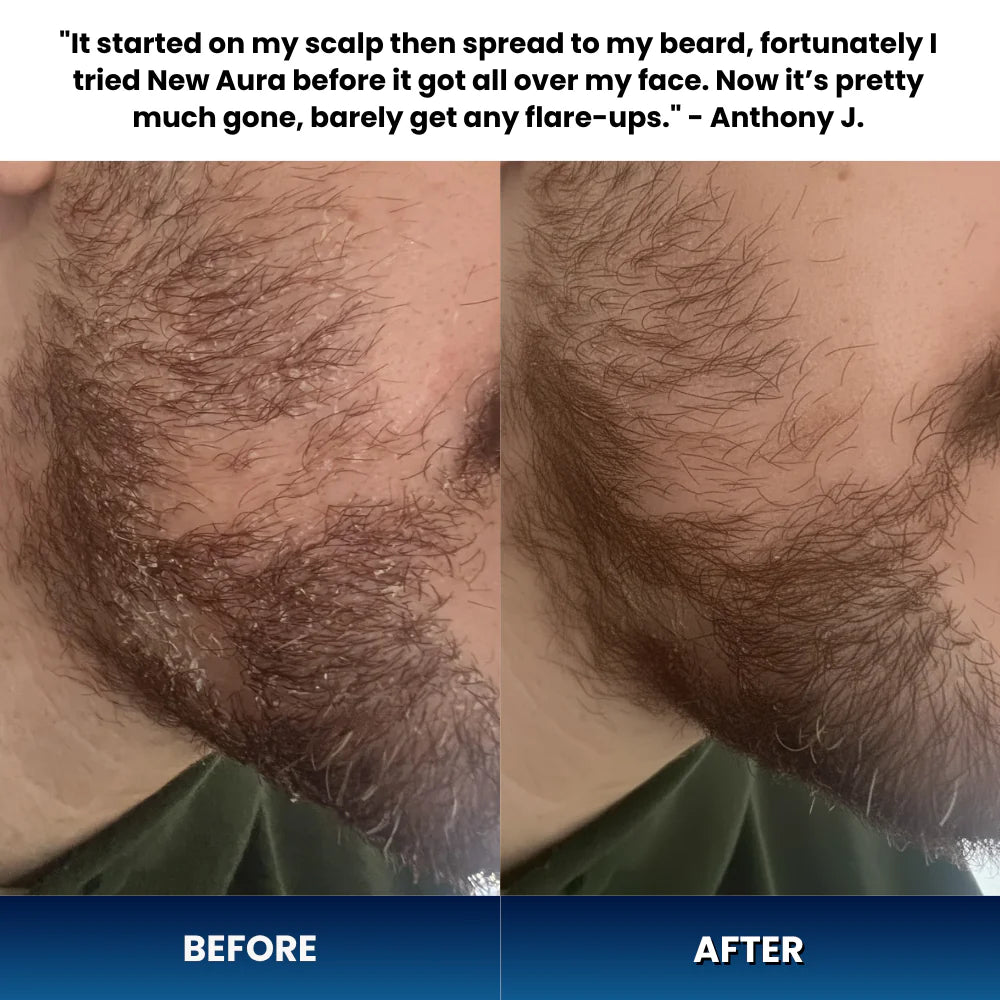 Men's Seb Derm Treatment